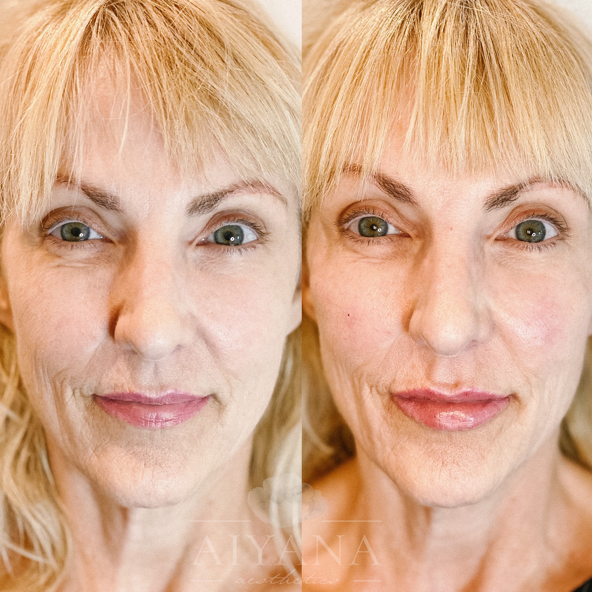 Deramal-Filler-midface-min.jpg