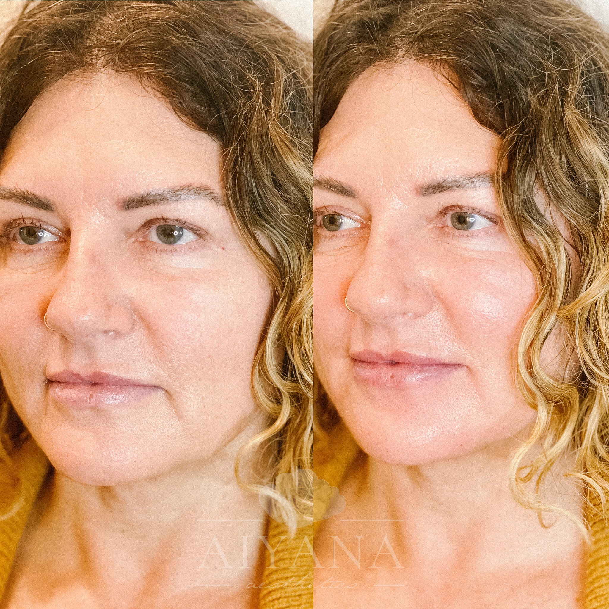 Dermal-Filler-Chin_prejowl-lips-min.jpg