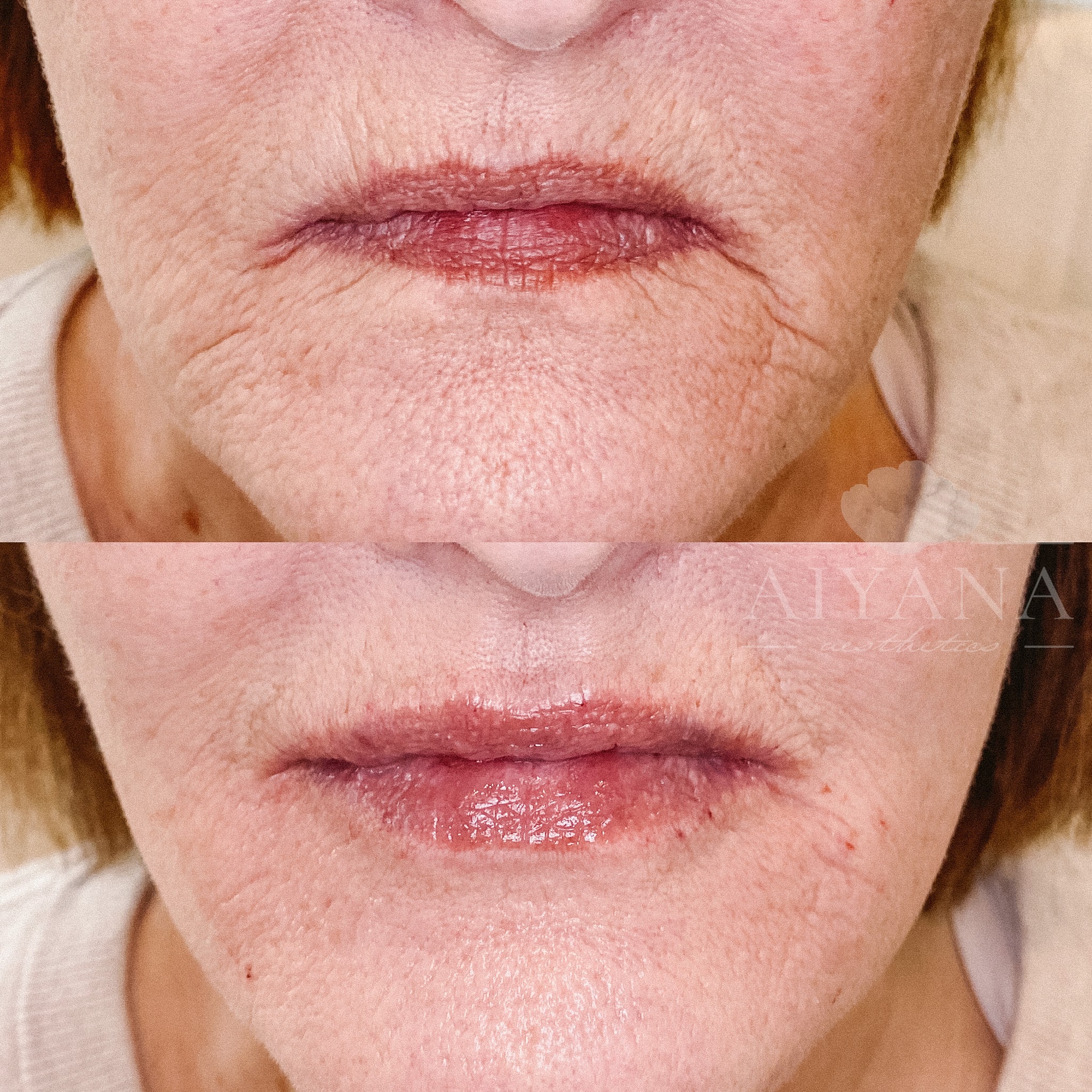 Dermal-Filler-Lips-marionettes-min.jpg