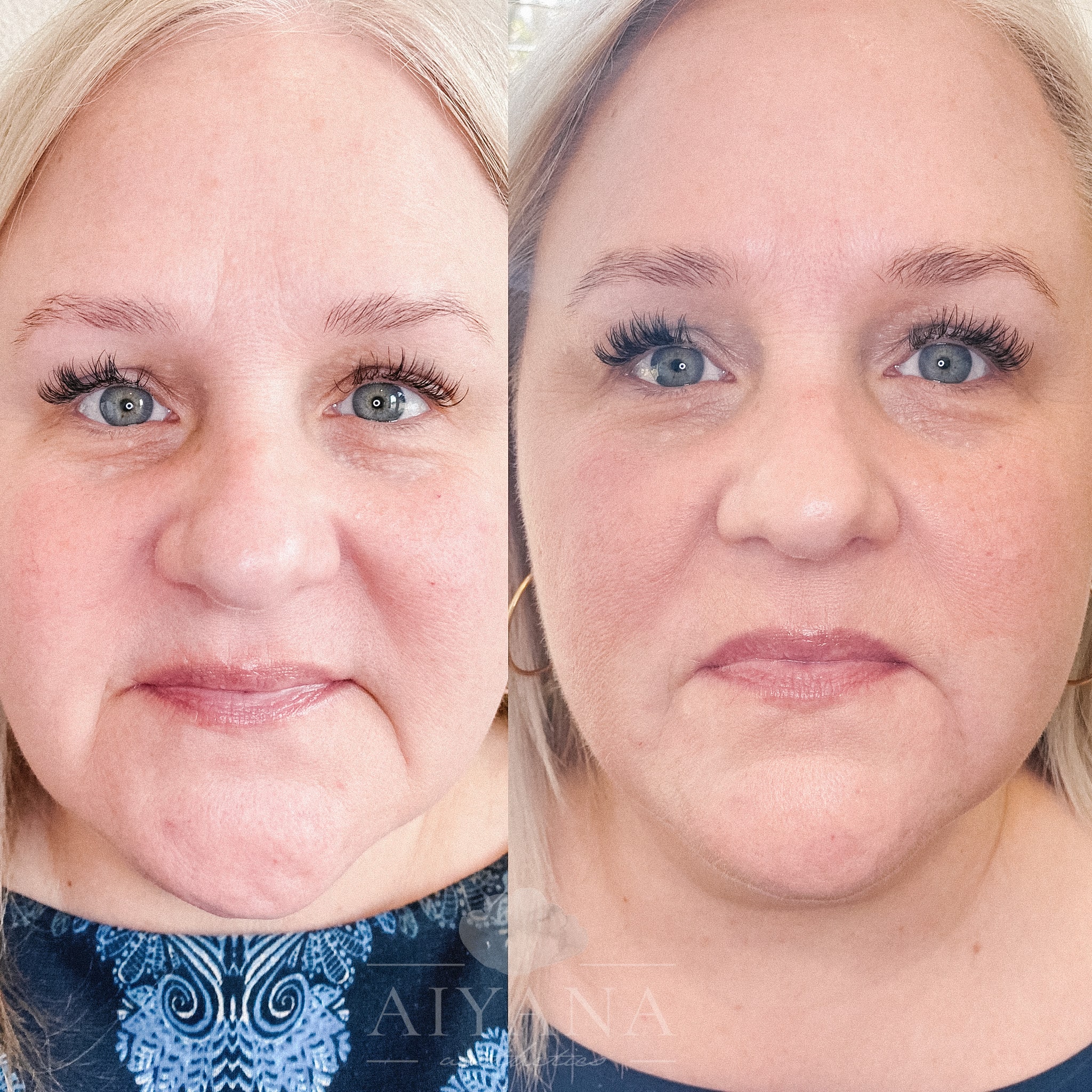 Dermal-Filler-Marionettes-min.jpg