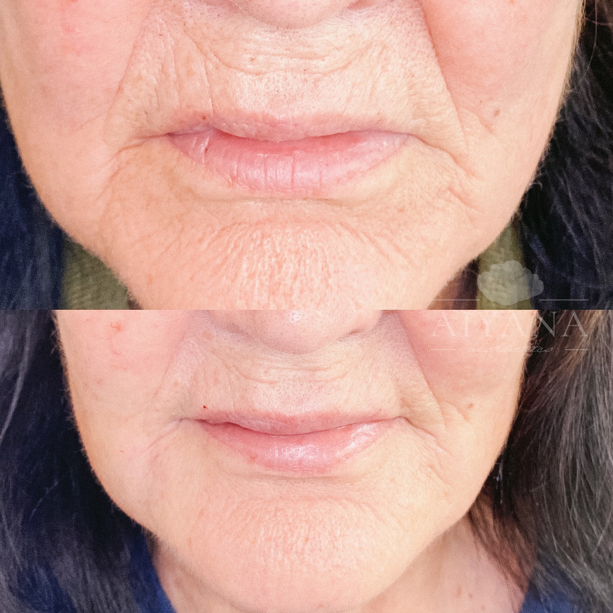 Dermal-Filler-Marionettes2-min.jpg