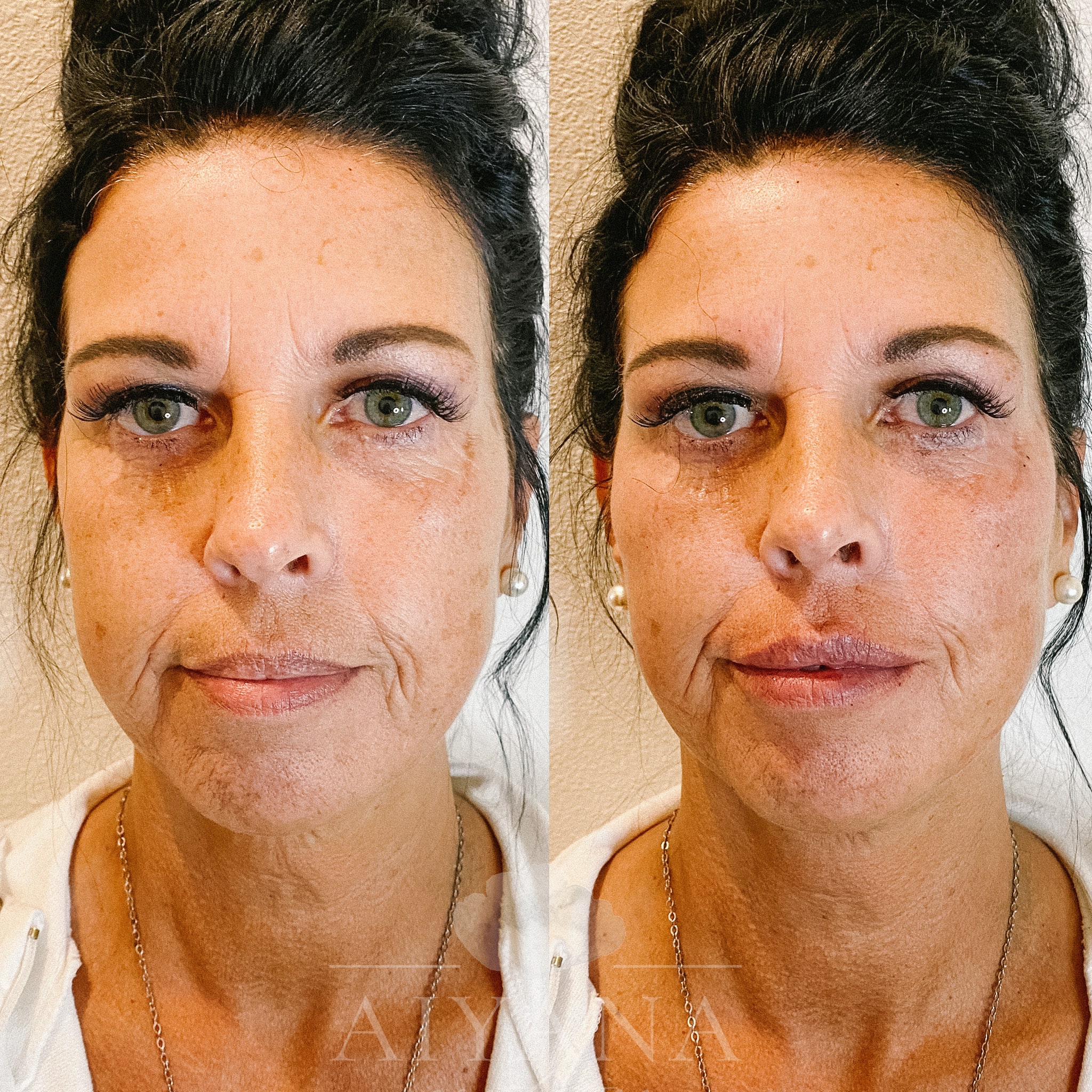 Dermal-Filler-Midface-cheeks-lips-min.jpg