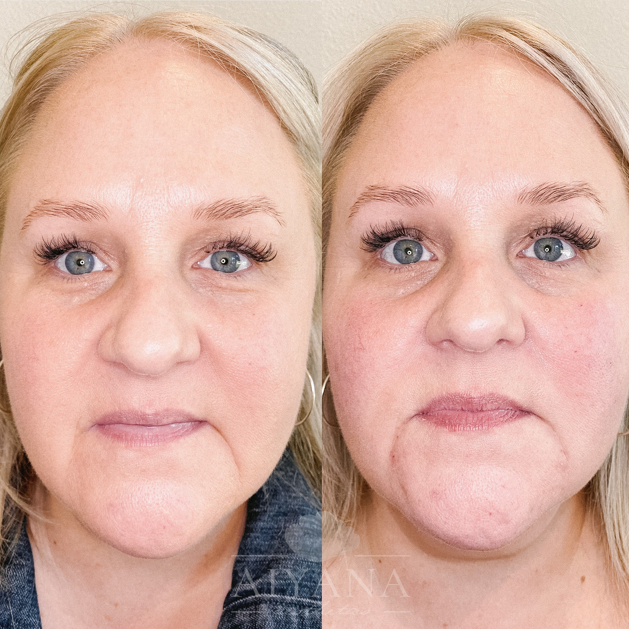 Dermal-Filler-Midface-cheeks-marionettesjpg-min.jpg