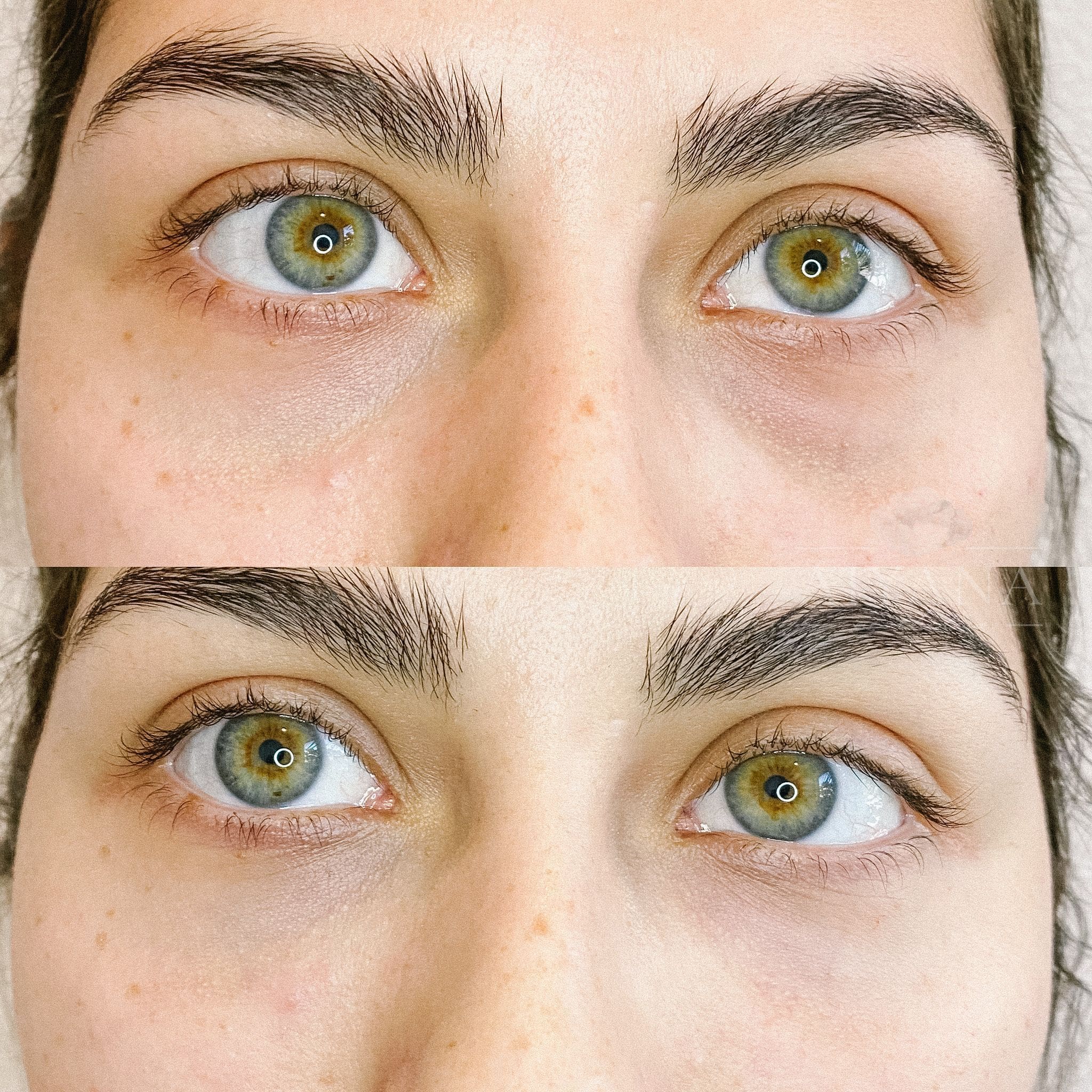 Dermal-Filler-Tear-Trough-min.jpeg