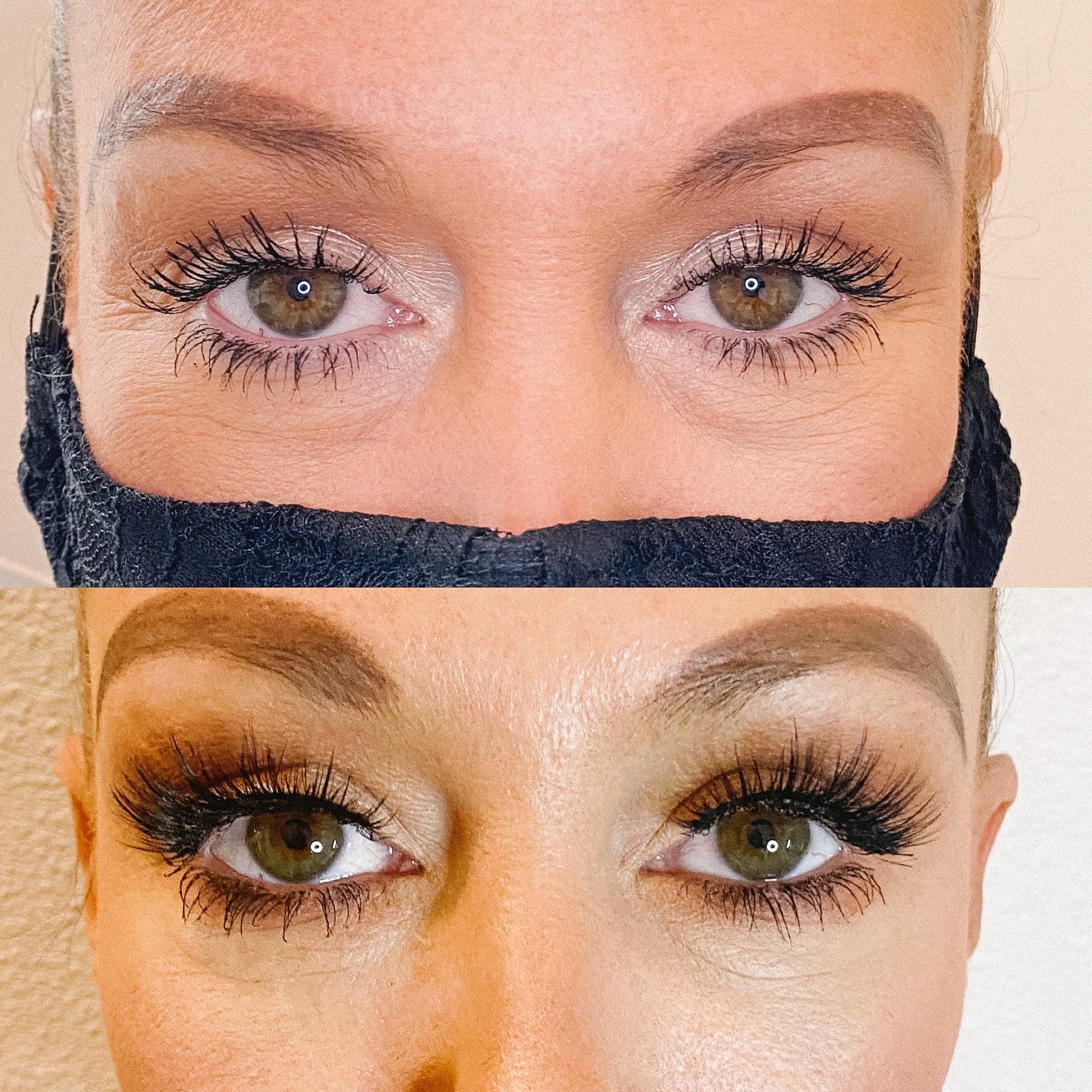 Dermal-Filler-Tear-Trough-min.jpg