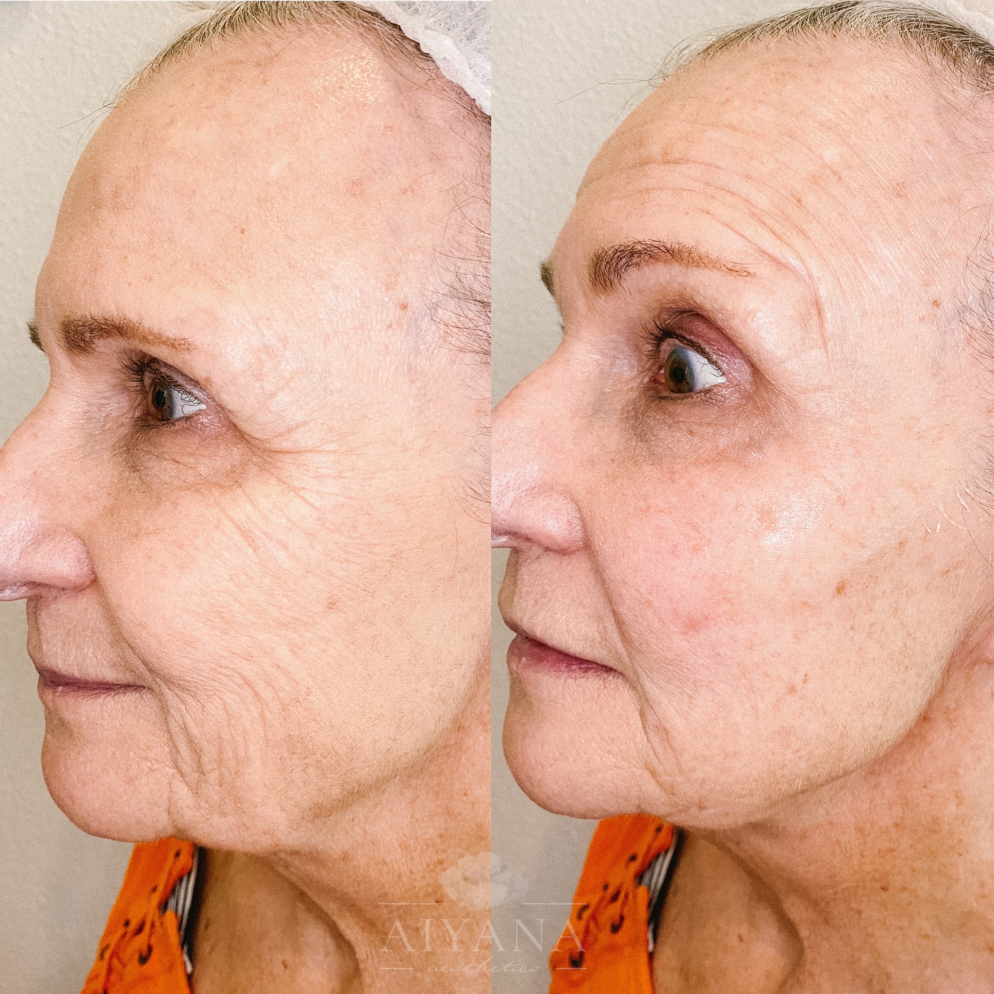 Dermal-filler-Mid-face-and-marionette-min.jpg