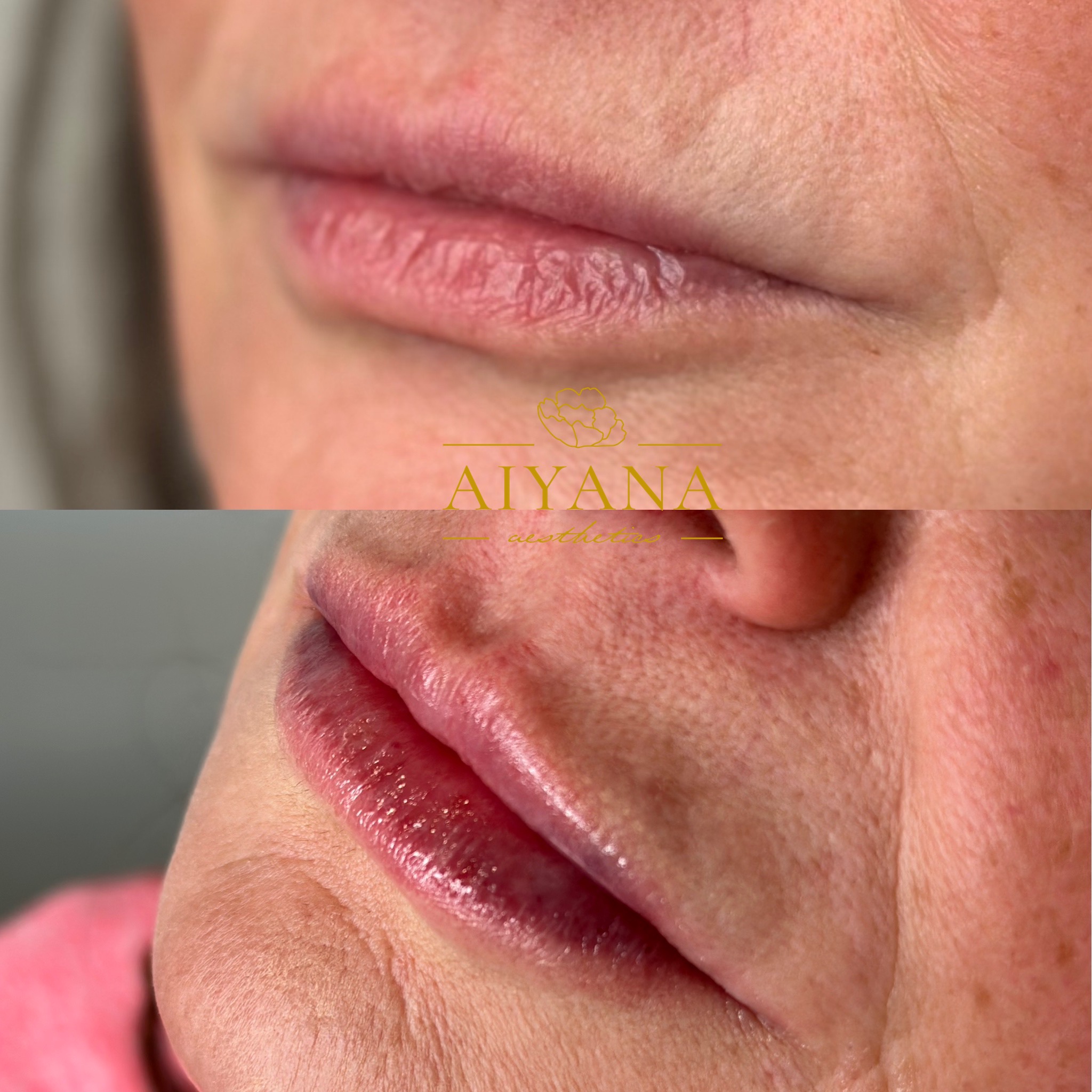 Lip-Filler-1.jpg