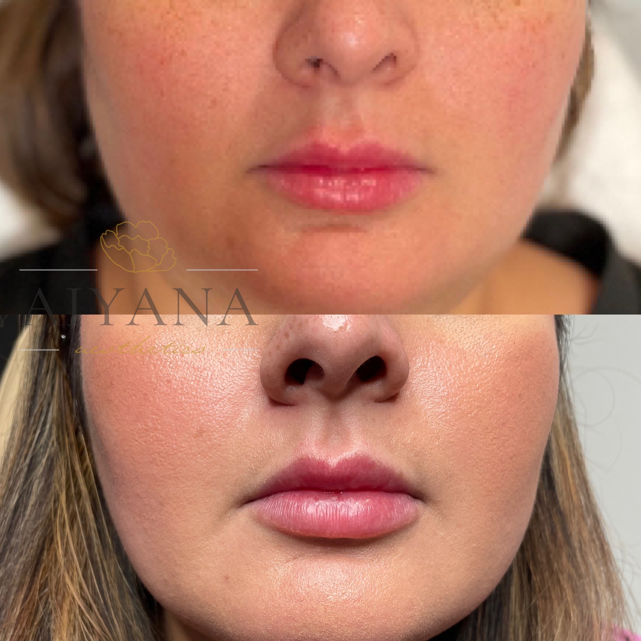 Lip-Filler.jpg