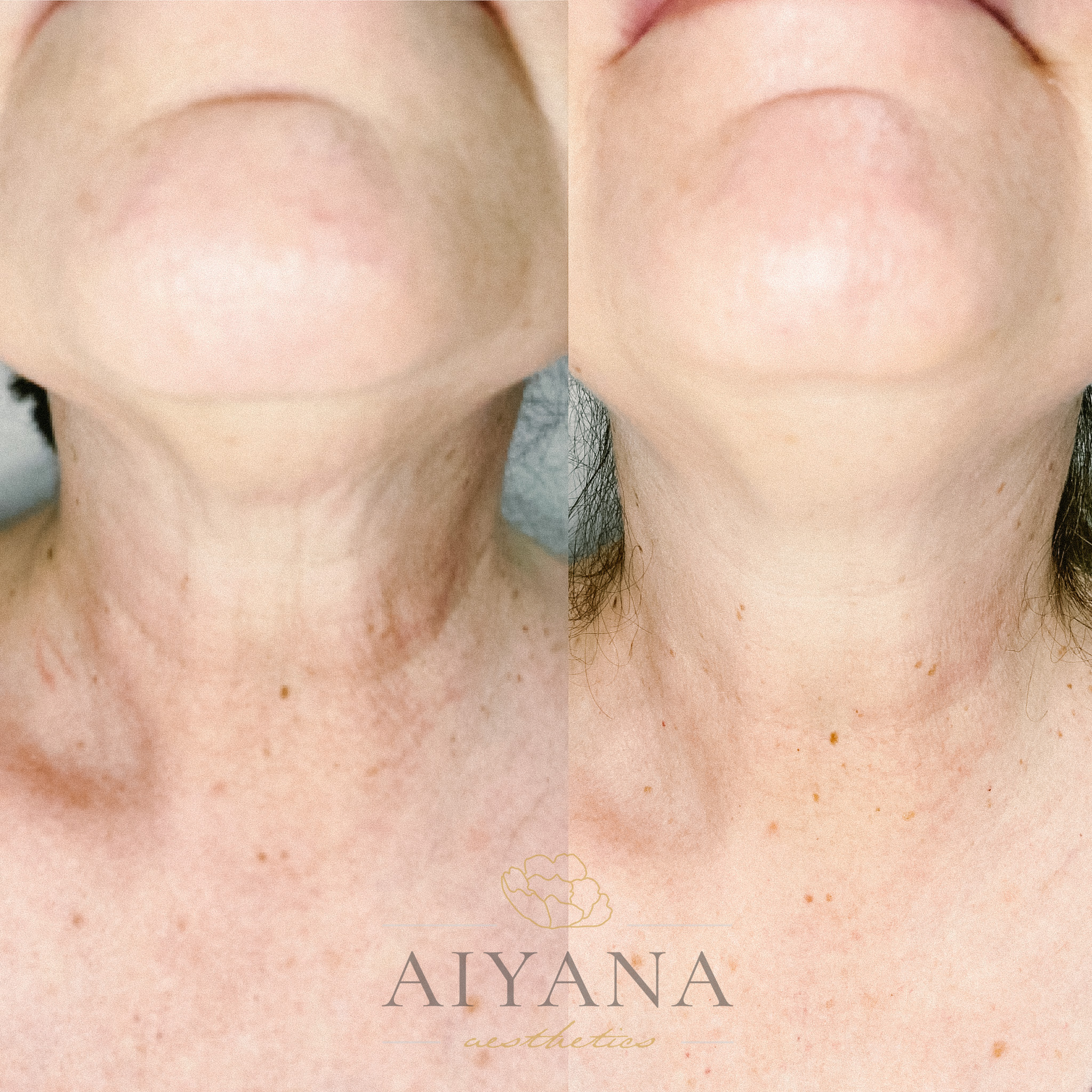Microneedling-on-Neck.jpg