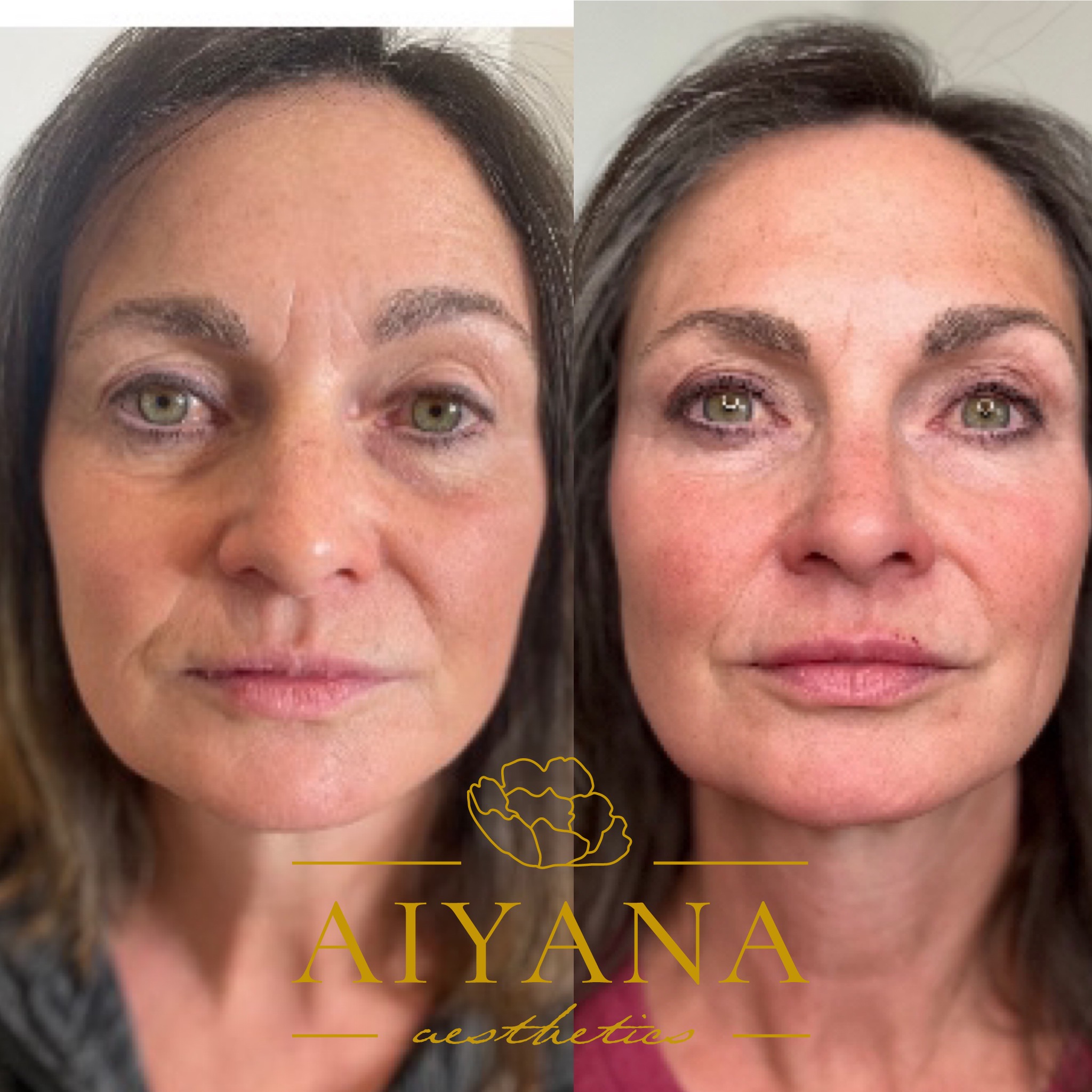 Midface_Lip-filler-Dysport_Microneedling_Skincare.jpg