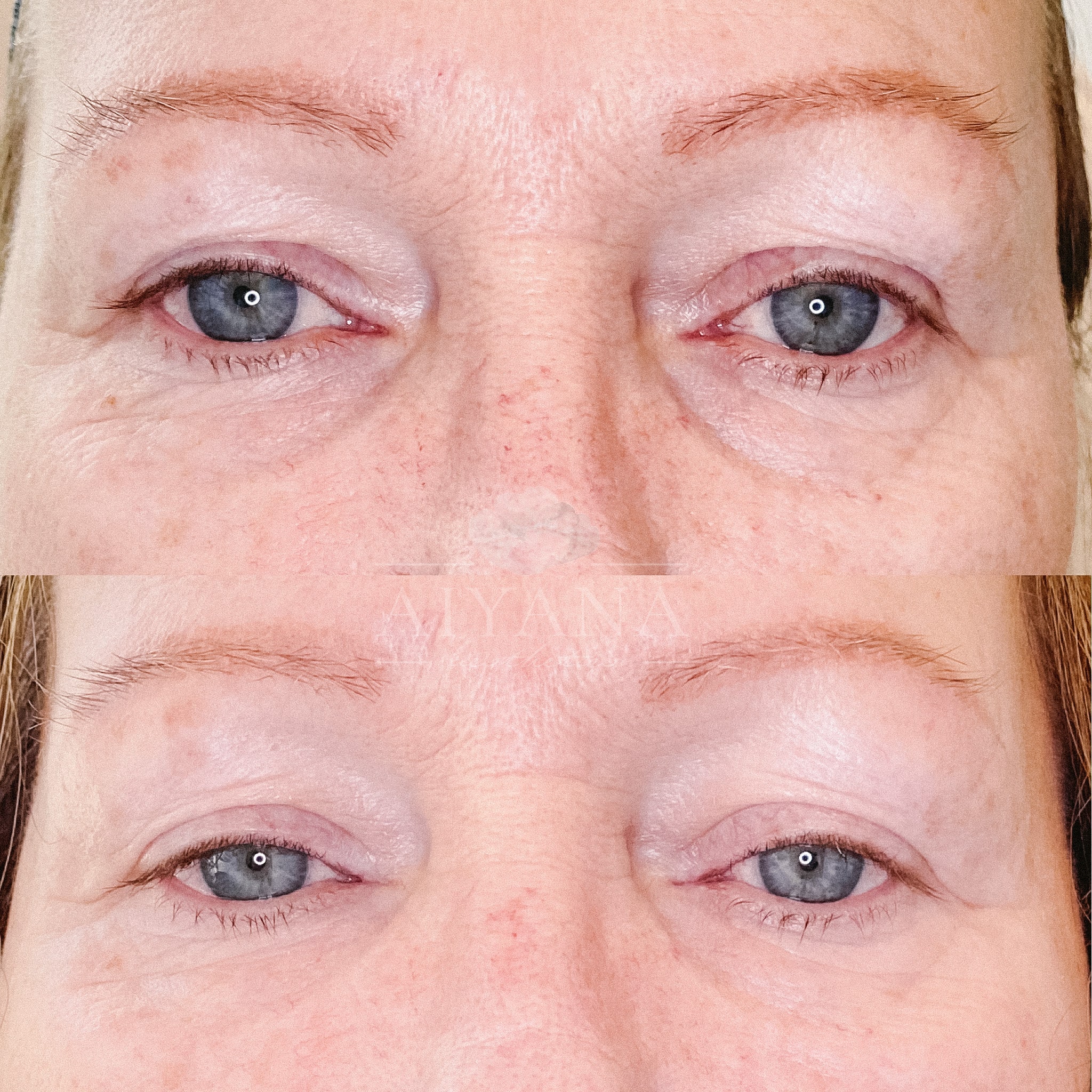 Neuromod-Microtox-to-undereyes-min.jpg