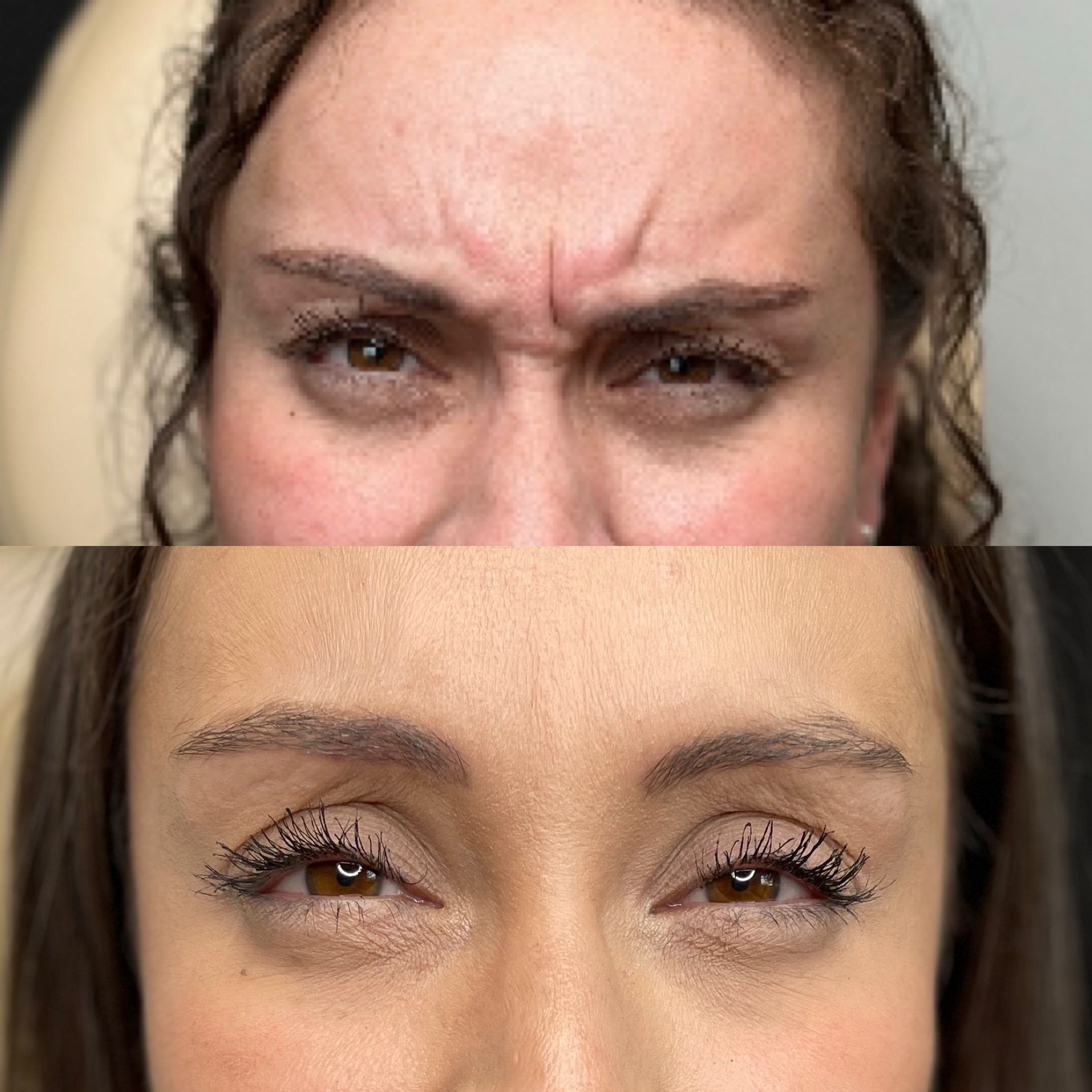 Scowl-line-botox.jpg