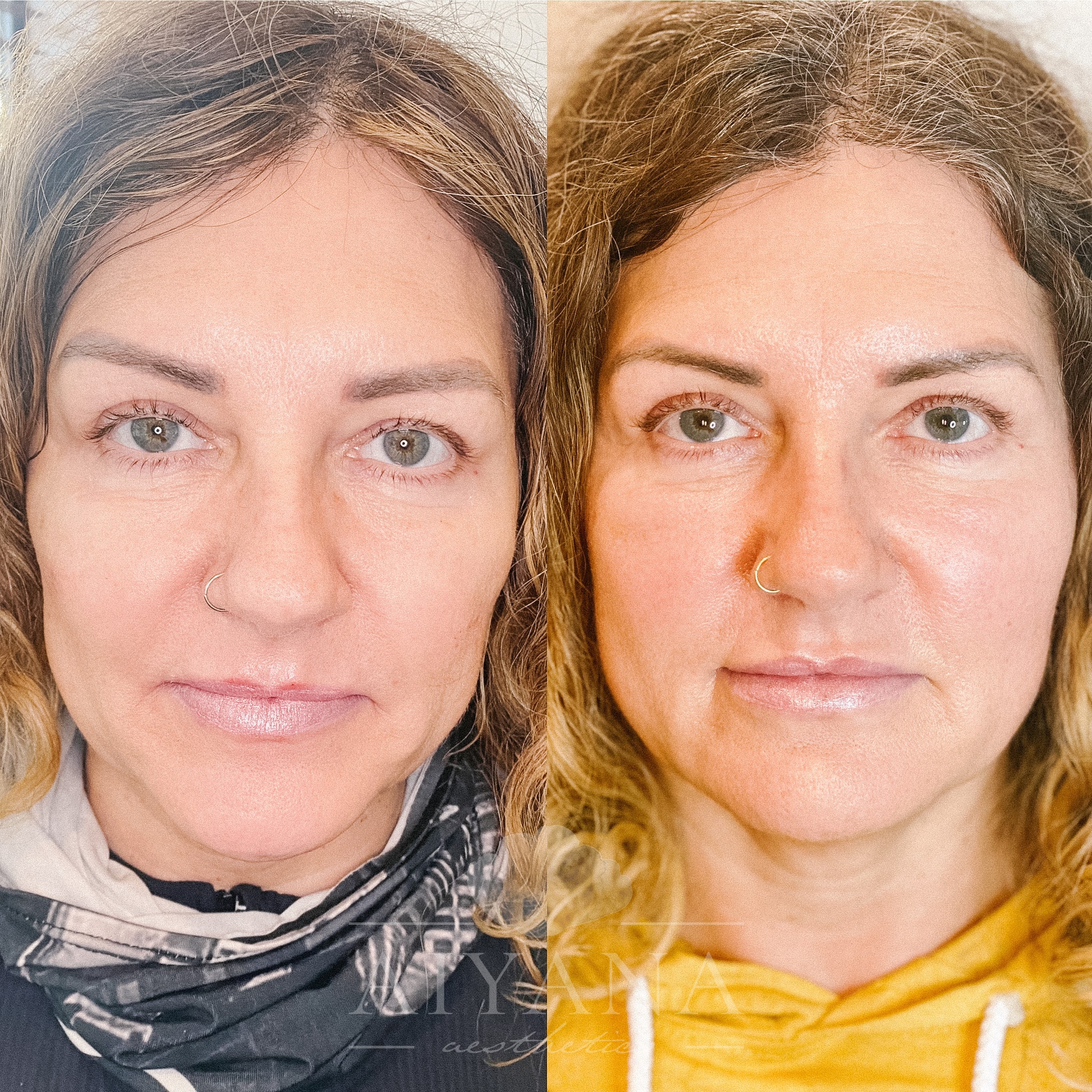 Sculptra-for-skin-glow-min.jpg