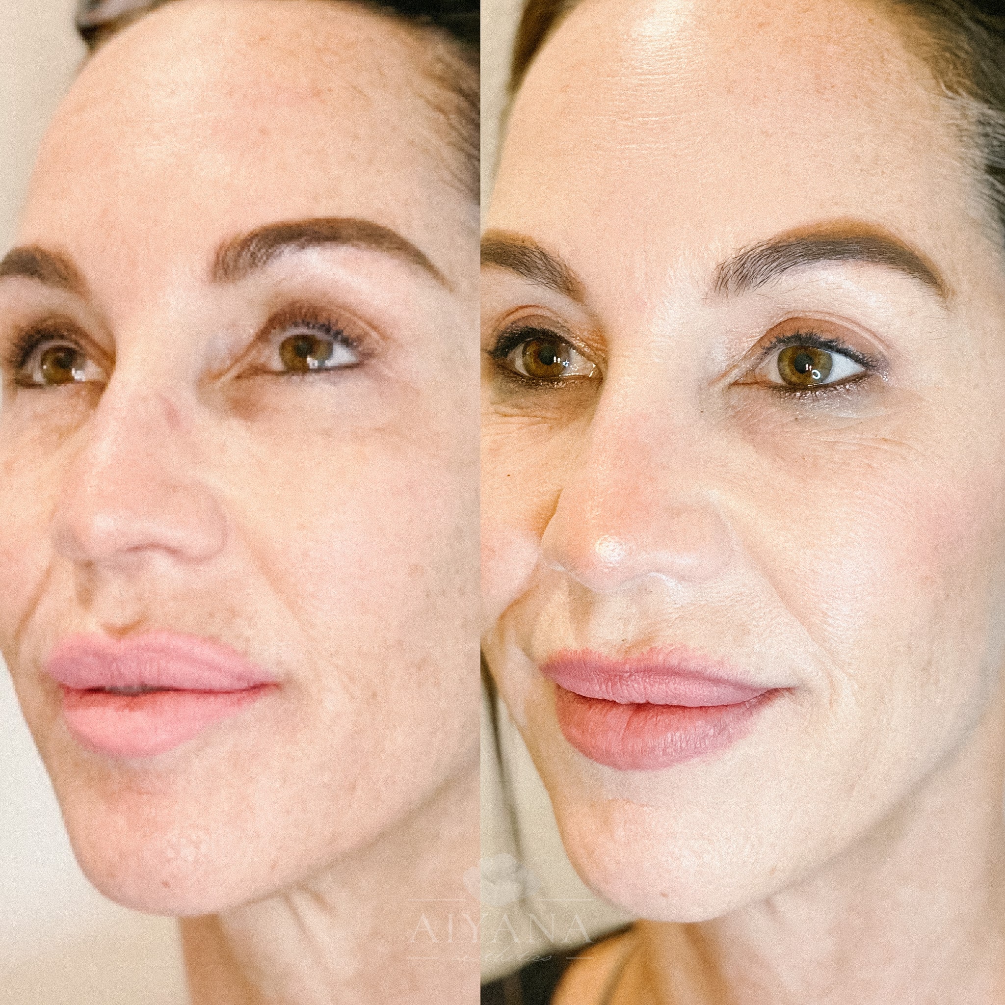 Sculptra-for-skin-tone-min.jpg