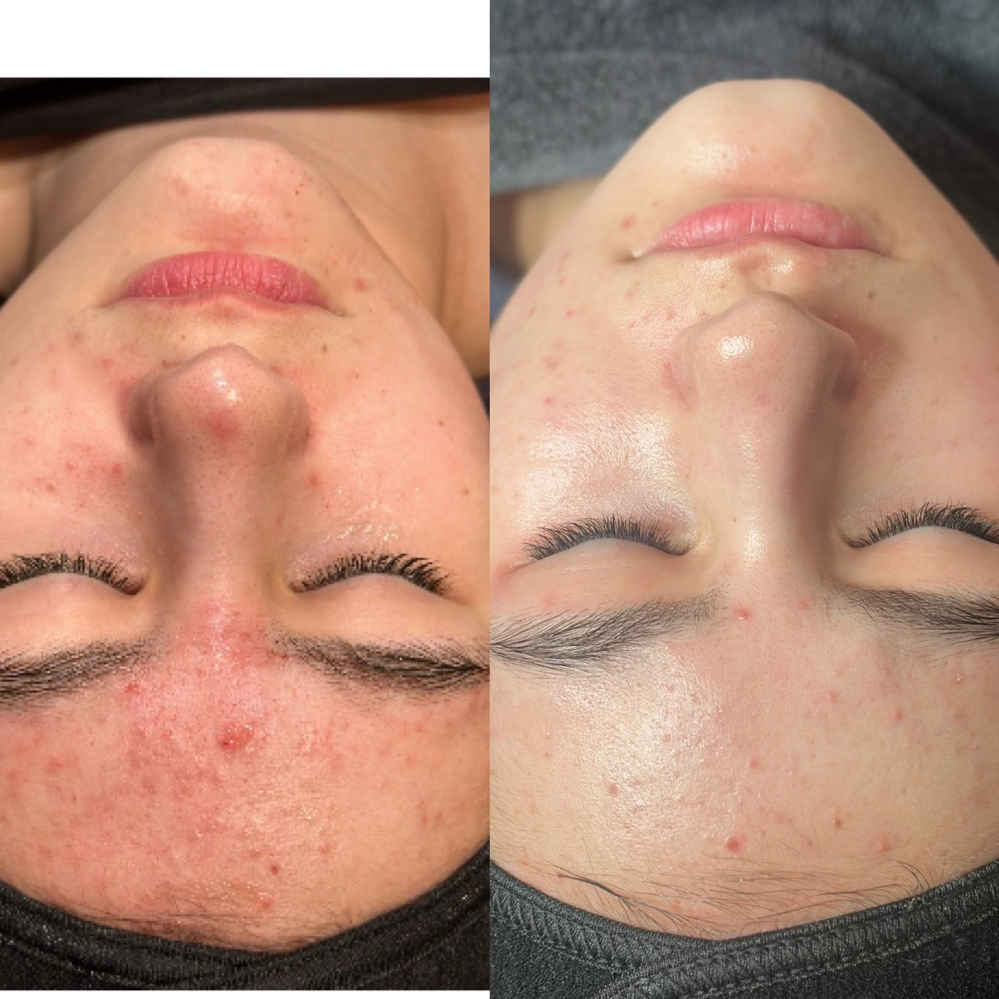 Teen-micro-acne.jpg