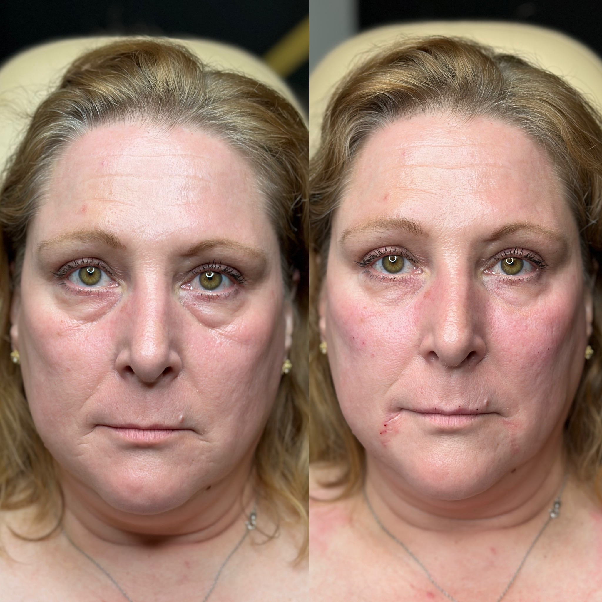 Under-eye-filler.jpg