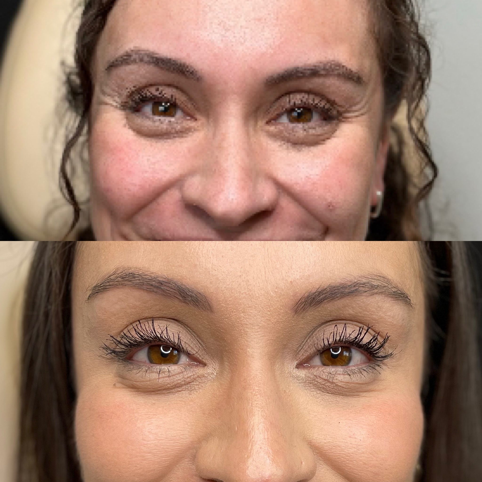 botox-around-eyes.jpg