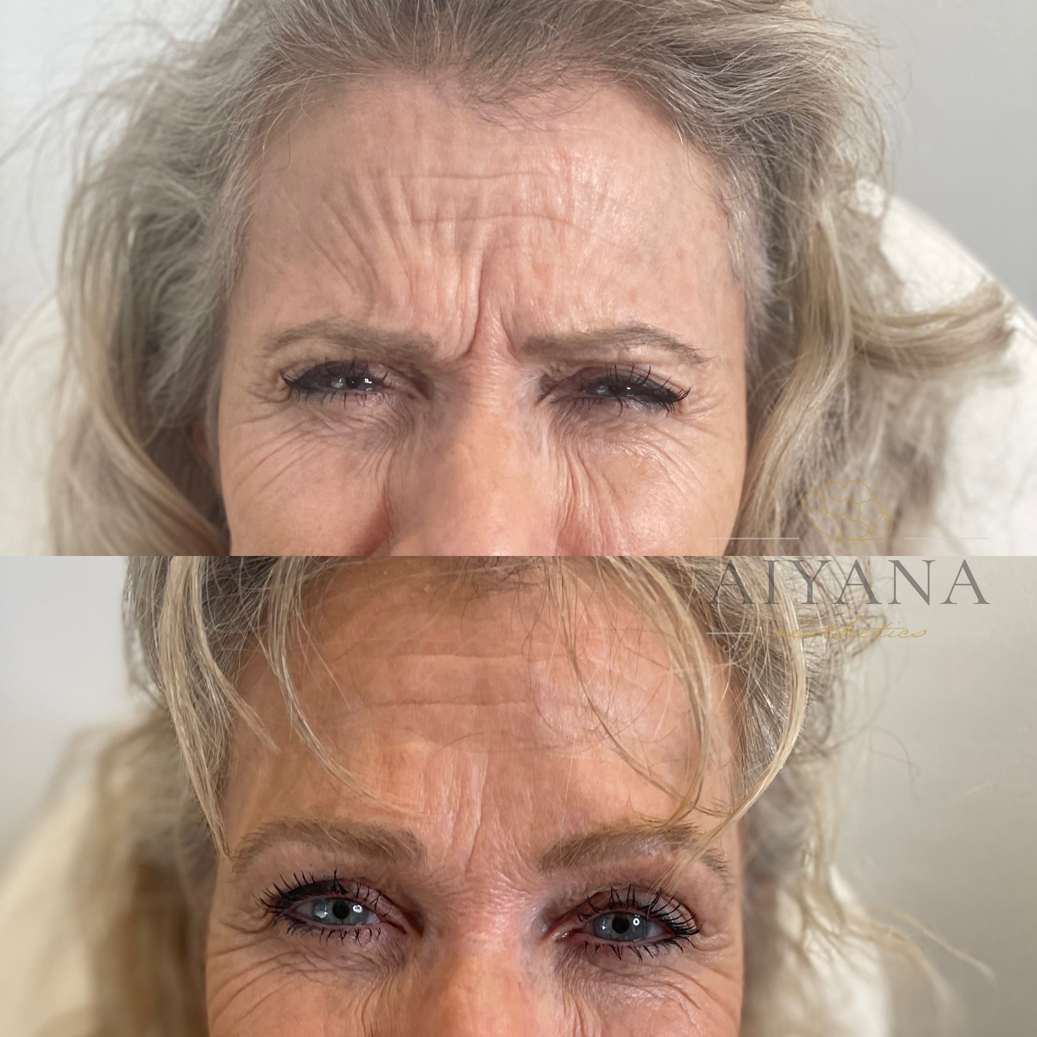 botox-in-scowl-lines.jpg