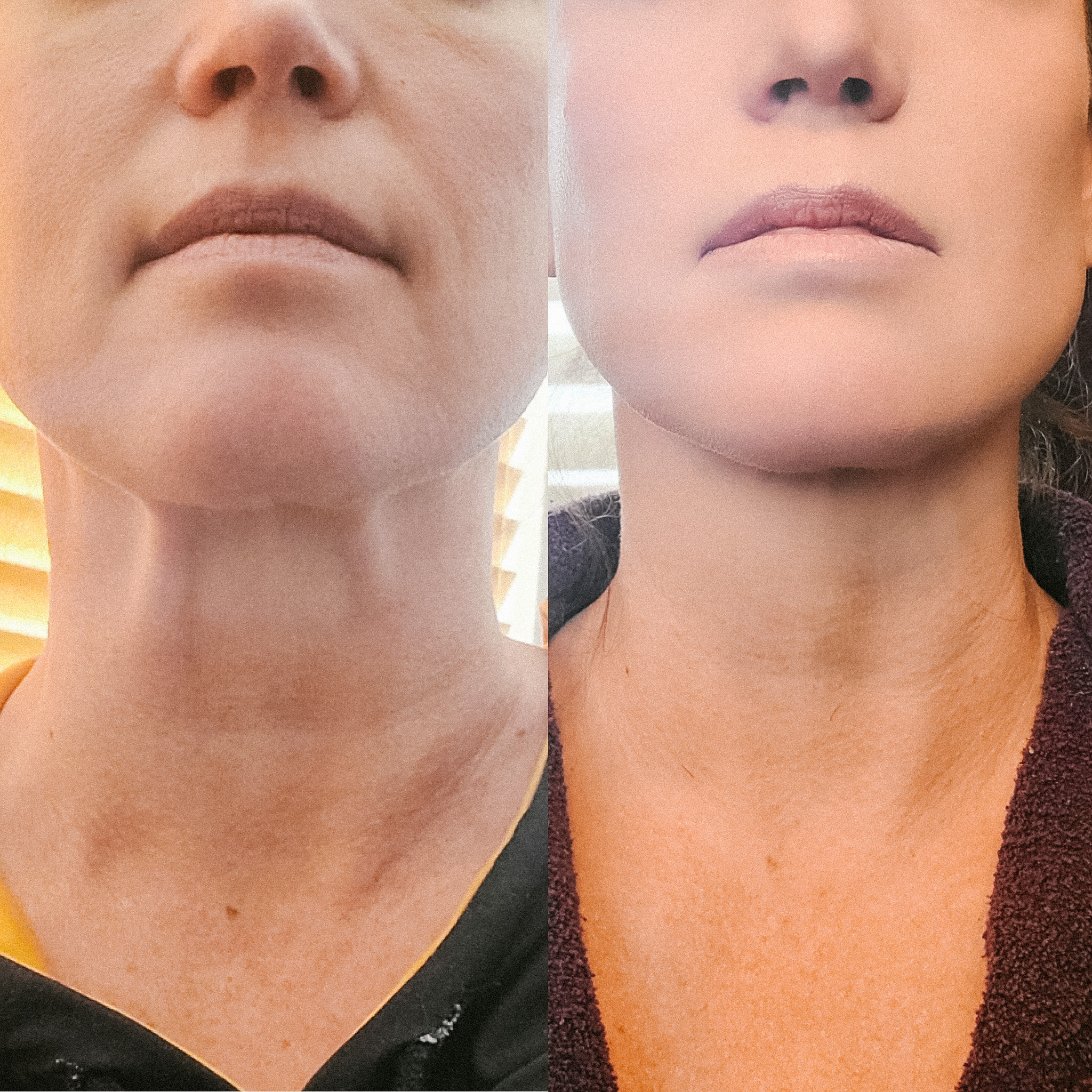 botox-platysma.jpg