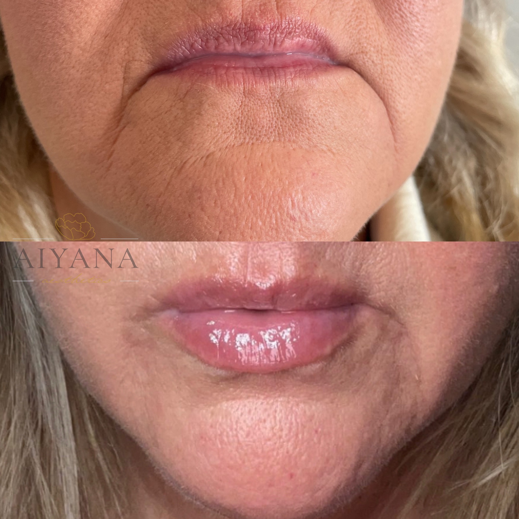 lips-and-marionettes.jpg