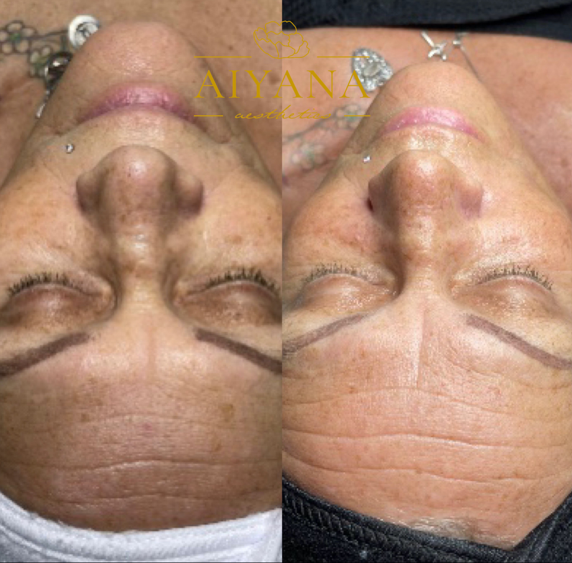 microneedling.jpg