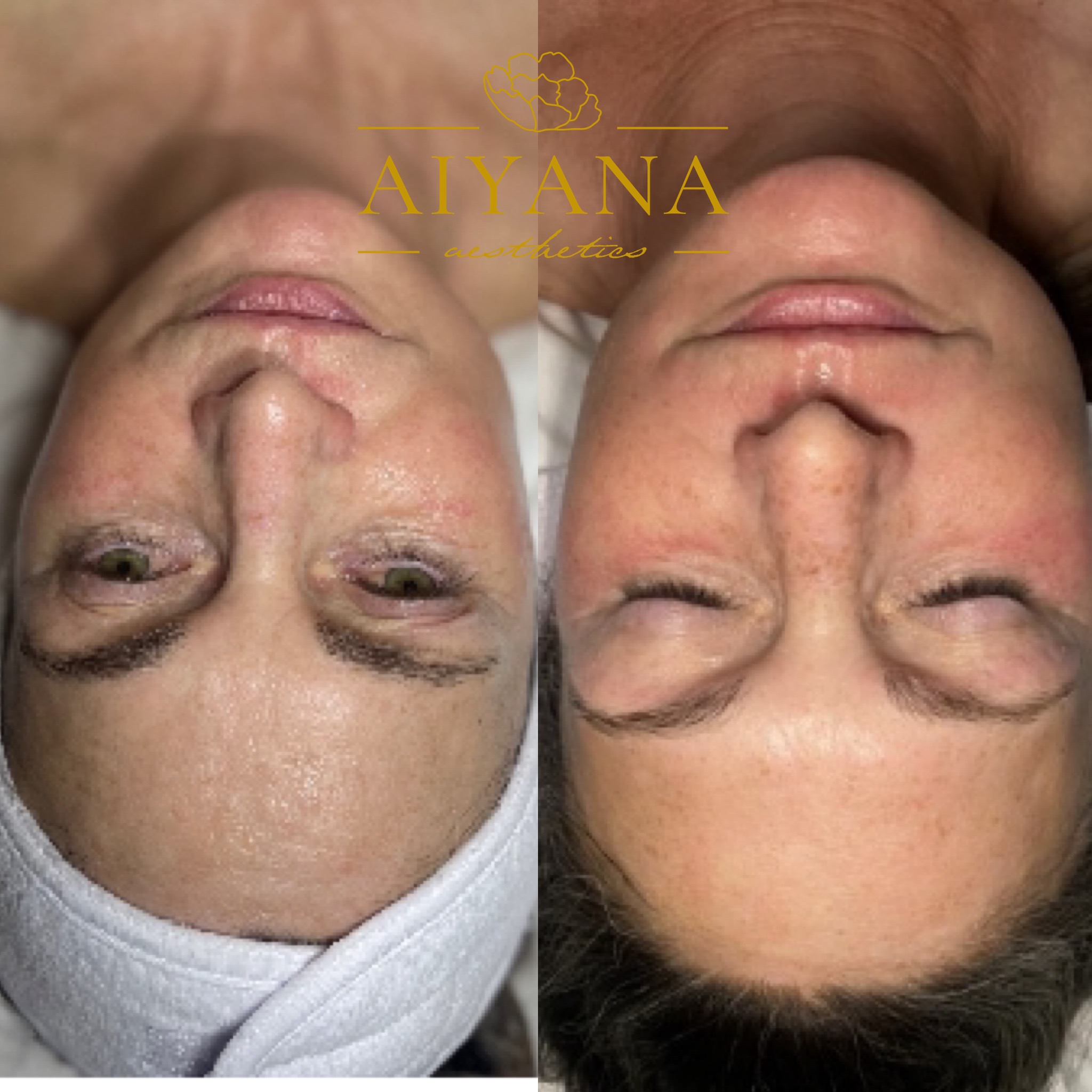 microneedling2.jpg