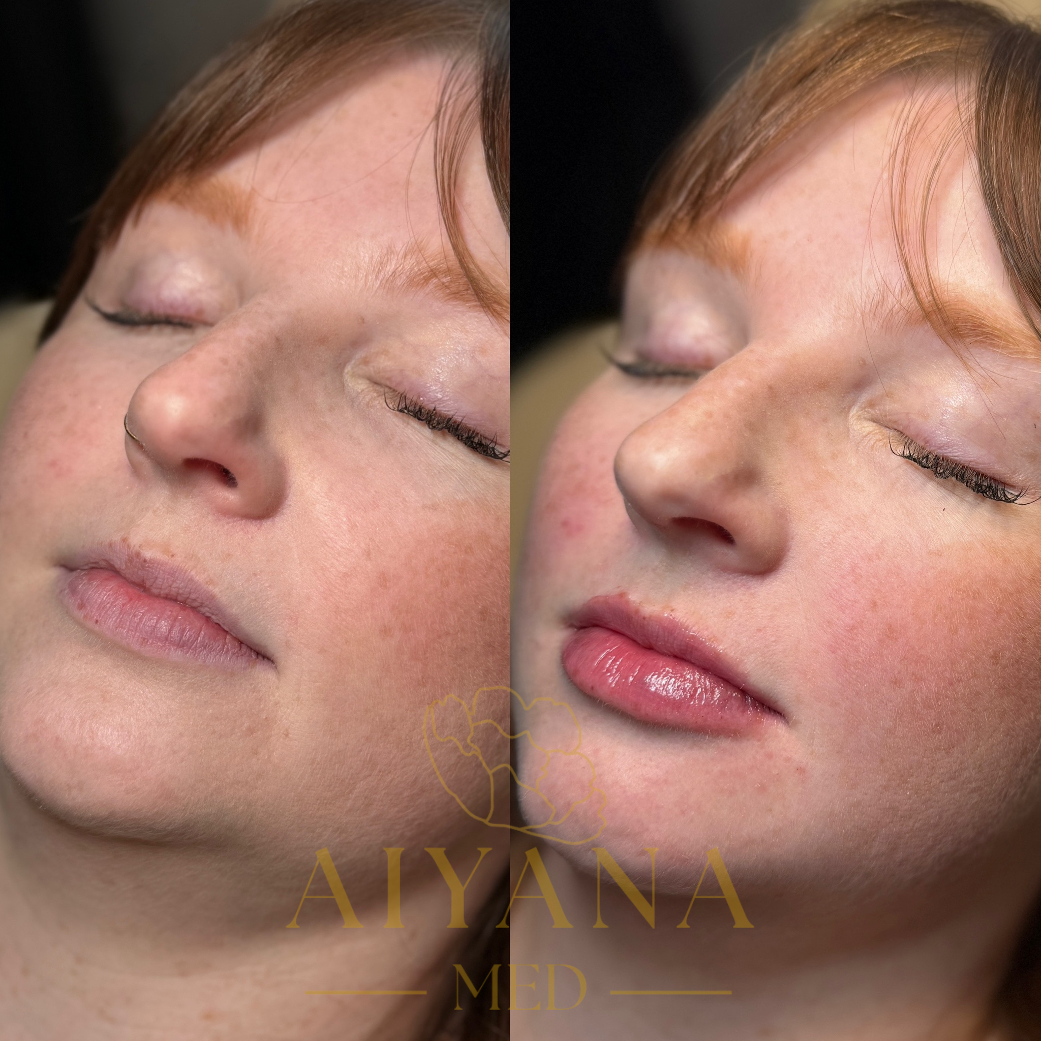 Lip Filler 1