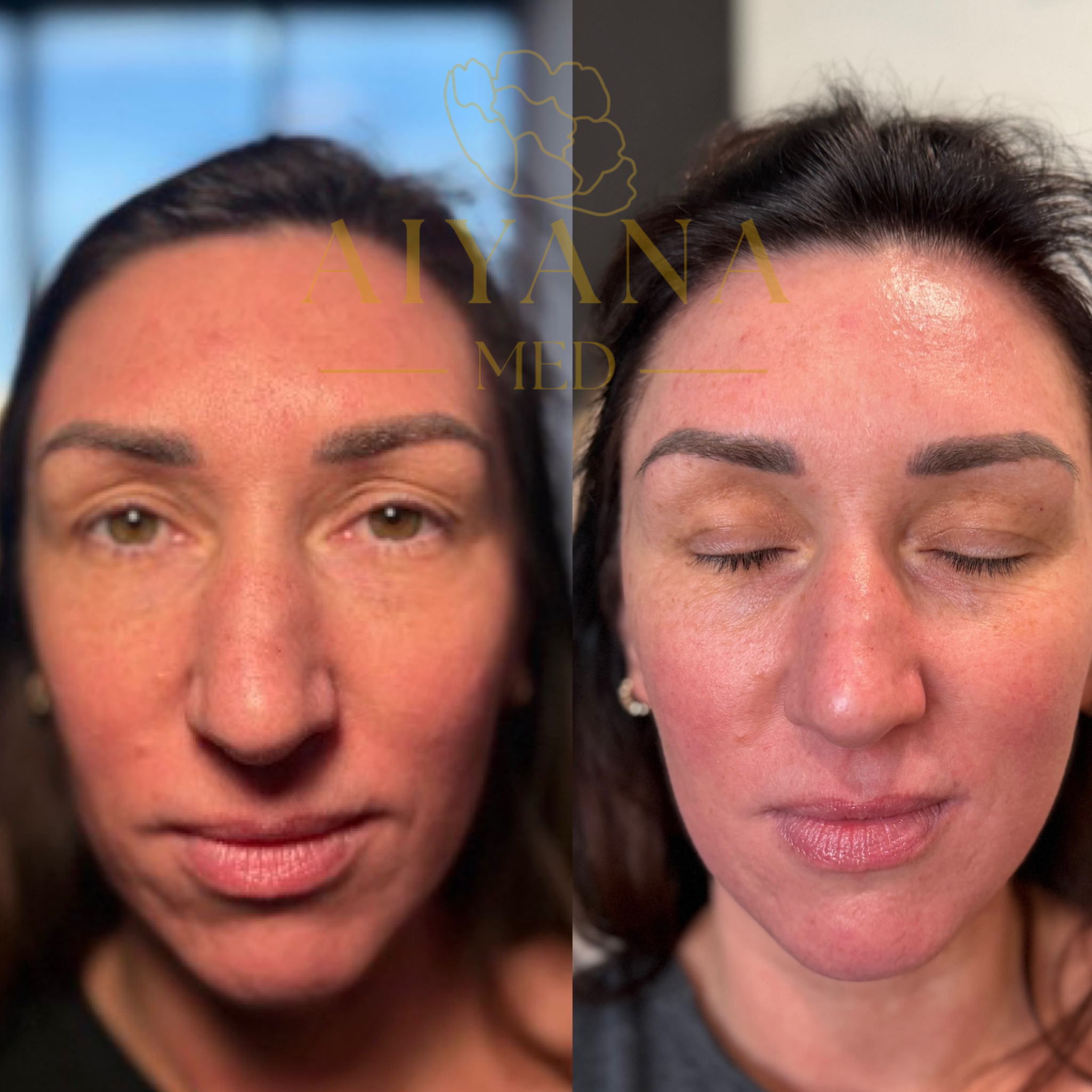 Sculptra 1